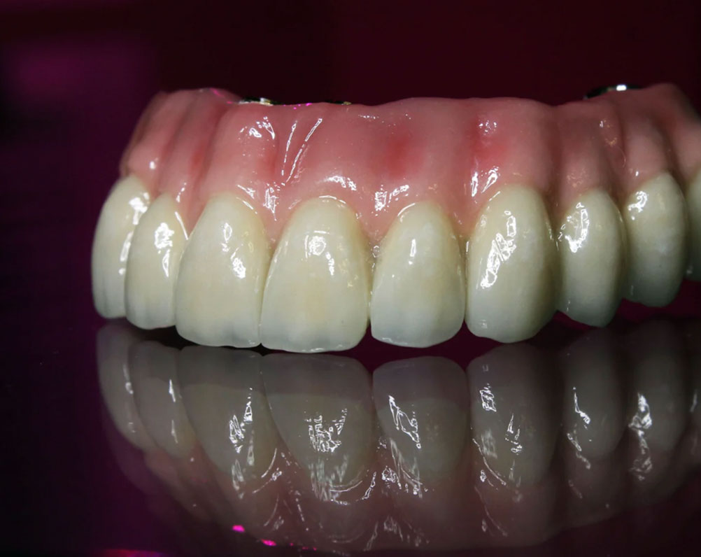 Prótese Fixa sobre Implantes em São Paulo