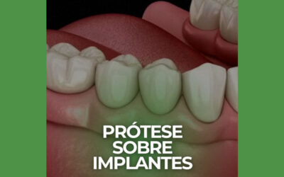 Prótese sobre implantes – Paraíso SP