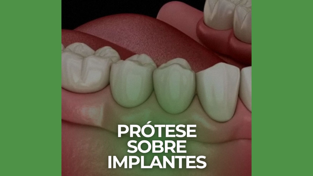Prótese sobre implantes – Paraíso SP