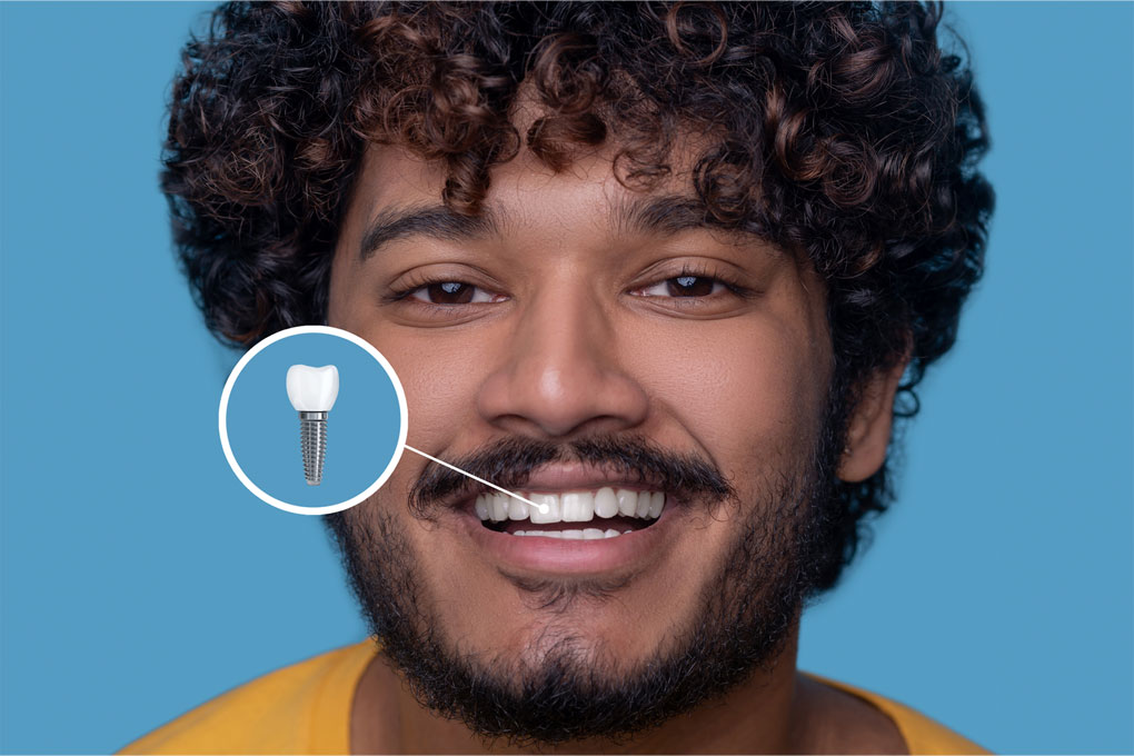 Implante Dentário em São Paulo