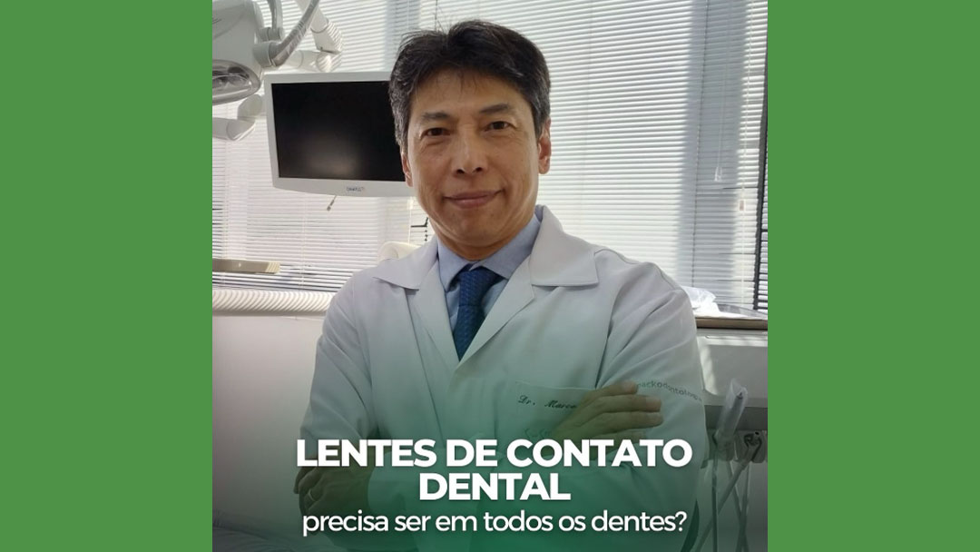 Lentes de Contato Dental: é preciso colocar em todos os dentes?