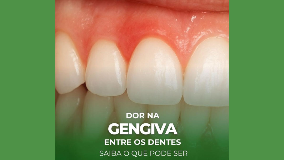O que pode ser dor na gengiva, entre os dentes?