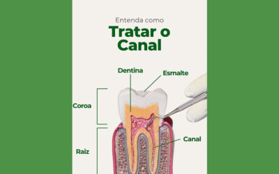 Como tratar o canal dentário?