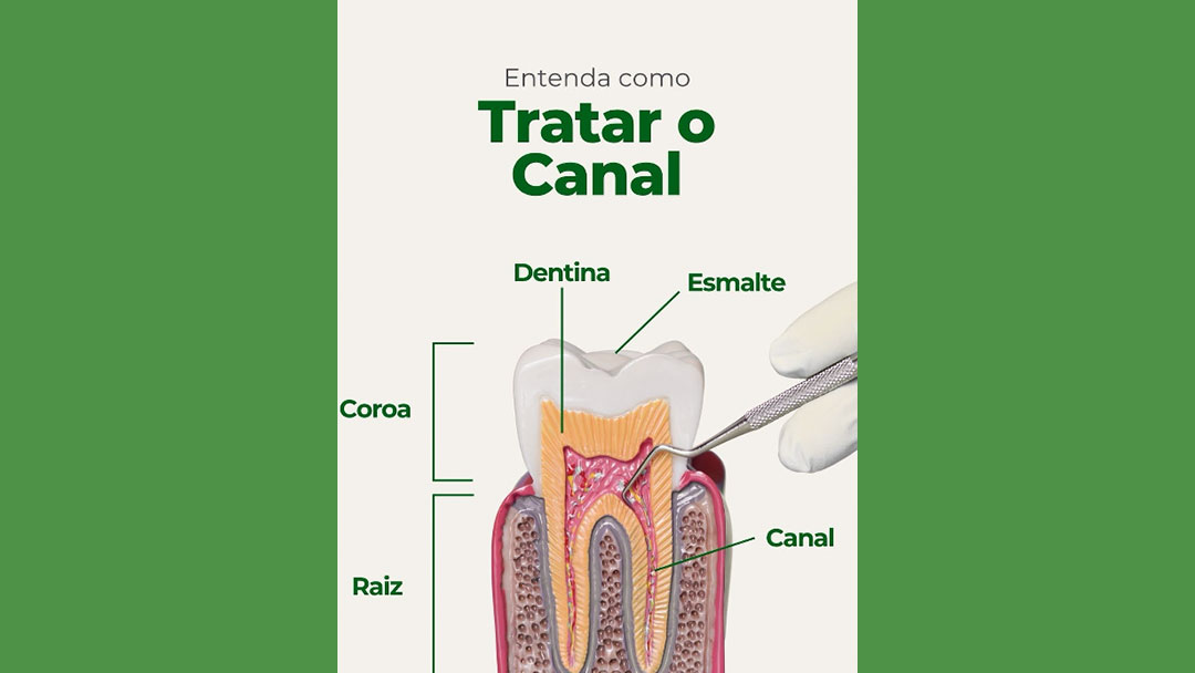 Como tratar o canal dentário?