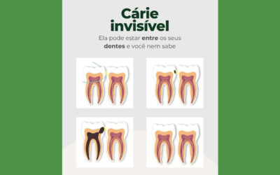 Cárie entre os dentes: sintomas, tratamento e prevenção