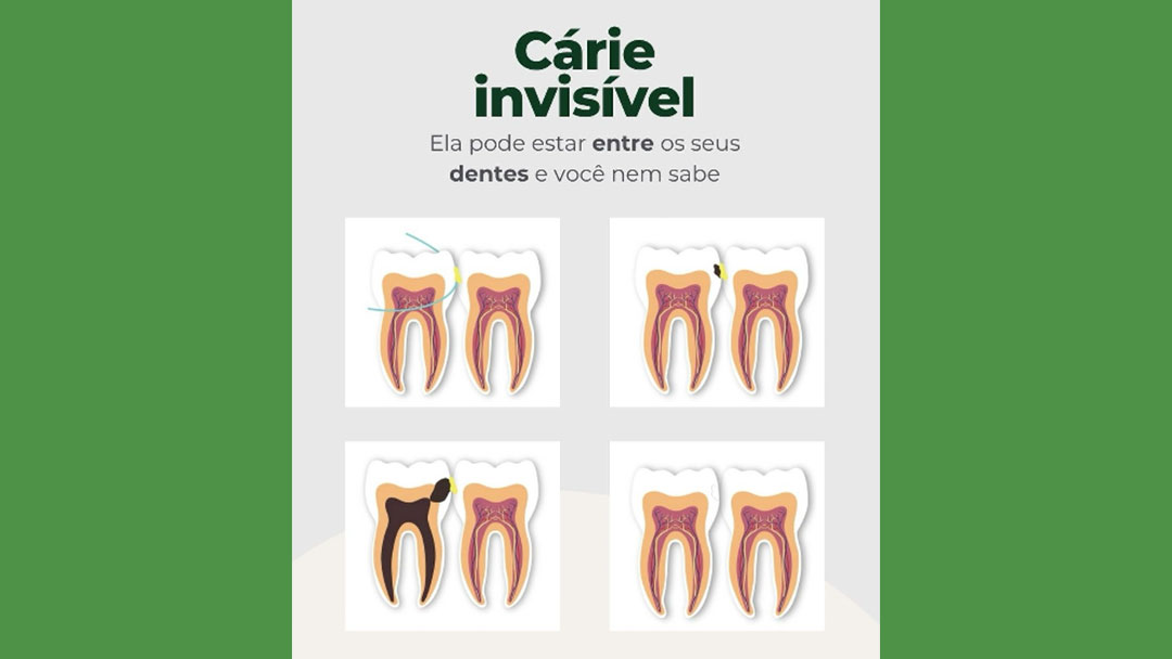 Cárie entre os dentes: sintomas, tratamento e prevenção