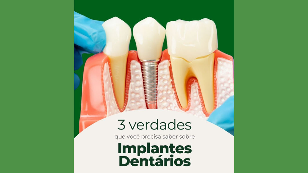 3 verdades sobre implantes