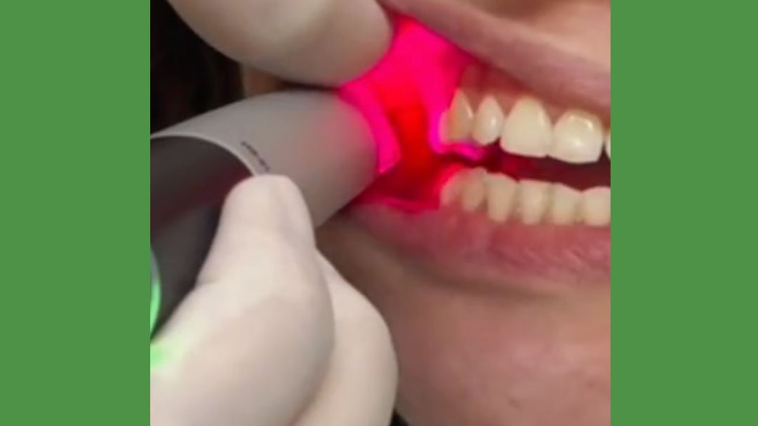 Como é feito o escaneamento intraoral?