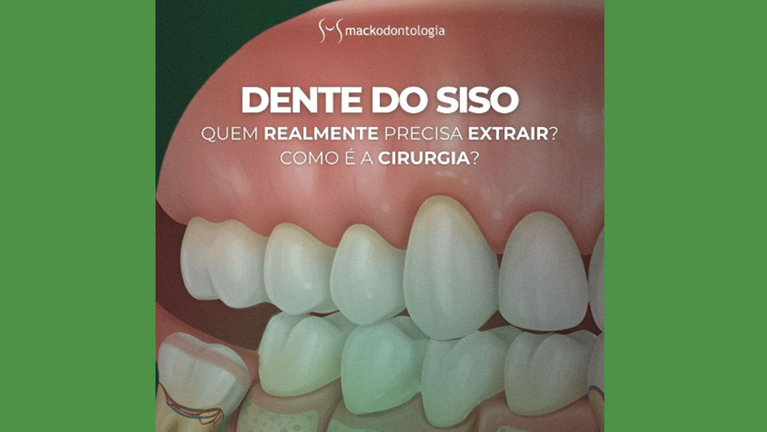 Dente do siso: quem realmente precisa extrair? Como é a cirurgia?