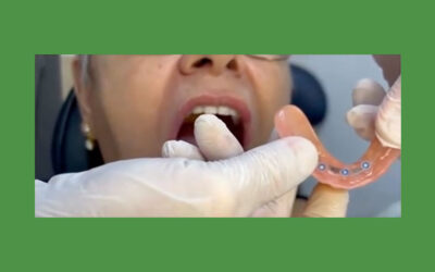Overdenture no Paraíso, SP: Mais estabilidade e segurança para o seu sorriso