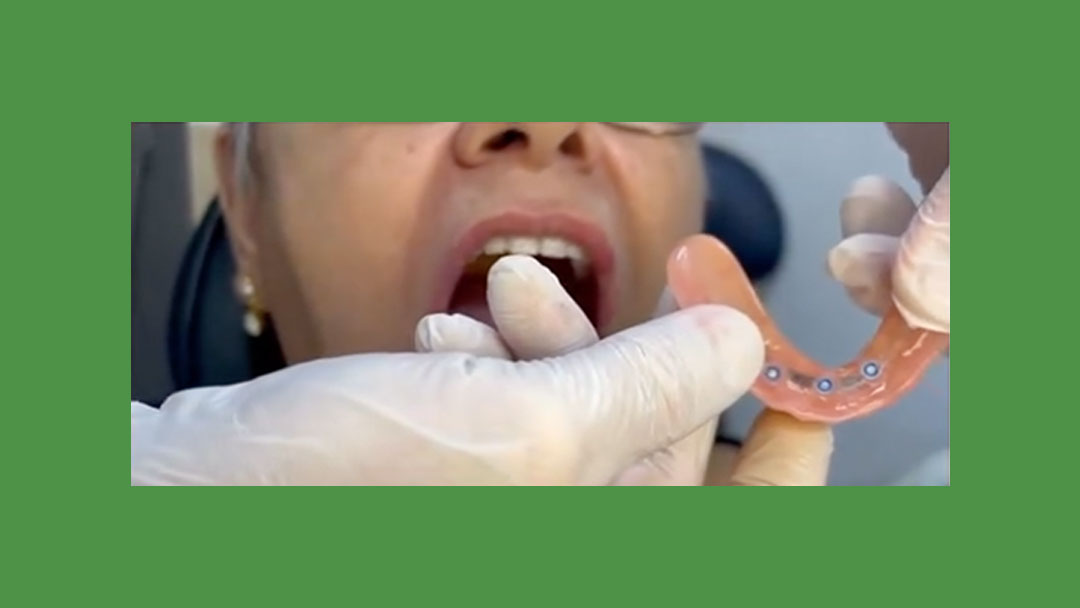 Overdenture no Paraíso, SP: Mais estabilidade e segurança para o seu sorriso